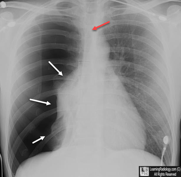 Simple pneumothorax